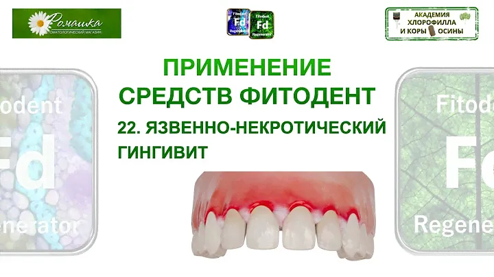 Применение средств Фитодент №22 Язвенно-некротический гингивит